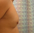 before chest lipo