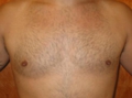 After chest lipo