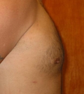 after chest lipo