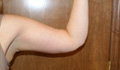 Arm Lift
