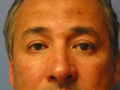 Blepharoplasty