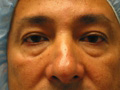 Blepharoplasty